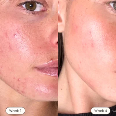 2025-03-05-PE748-shopify-before-after-red-light-therapy.webp