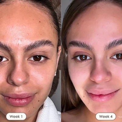 2025-03-13-PE748-shopify-before-after-red-light-therapy.webp