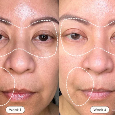 2025-PE748-shopify-before-after-red-light-therapy.webp